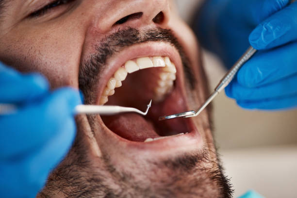 Best Emergency Dentist for Lost Fillings or Crowns in Blanding, UT